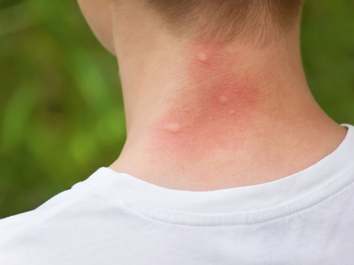 Bites and Stings
