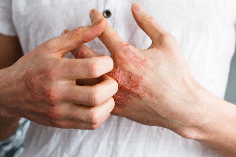 Eczema and Dry skin