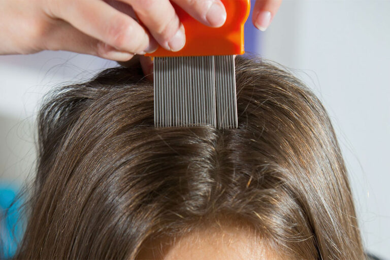 Head lice