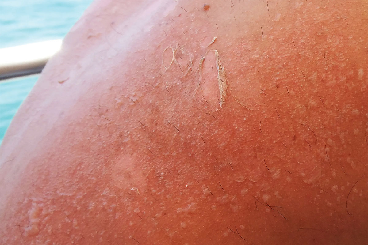 Minor Burns